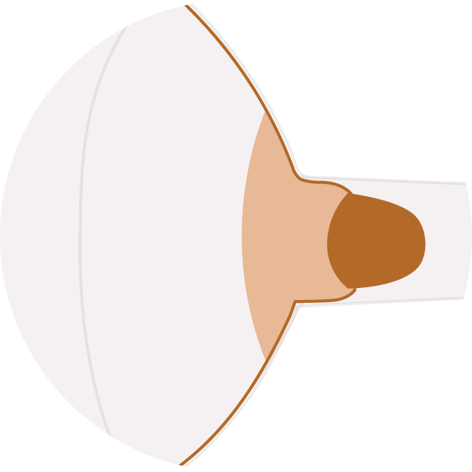 Flange too large: the areola is pulled into the tunnel